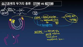 심근경색의 두가지 종류  STEMI와 NSTEMI [upl. by Lundberg706]