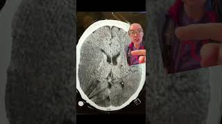 Answer to case study 77  MCA stroke treated by hemicraniectomy casestudy stroke neurosurgery [upl. by Detta]