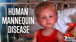 Worlds Rarest Disease The Human Mannequin  Documentary [upl. by Bronwen]