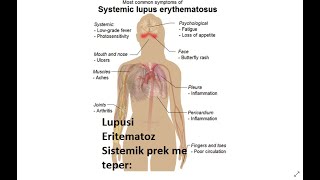 Lupusi Eritematoz Sistemik LES [upl. by Ludovika]