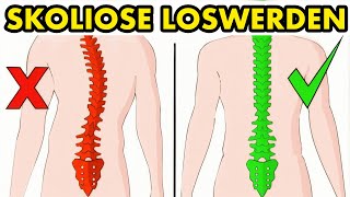Wie man Skoliose auf natürliche Weise in 5 Minuten am Tag beheben kann [upl. by Pussej991]