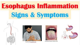 Esophagitis Esophagus Inflammation Signs amp Symptoms amp Why They Occur [upl. by Llerihs262]