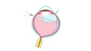 Retinal Detachment Treatment—Pars Plana Vitrectomy [upl. by Madison]