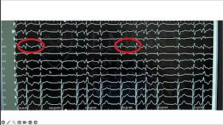 Mitral Annular Disjunction and Arrhythmias [upl. by Assir]