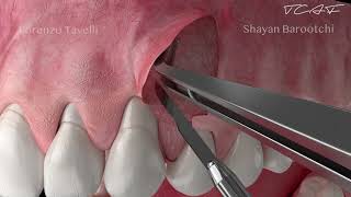 Dental Animation  The Tunneled Coronally Advanced Flap TCAF [upl. by Aicelf12]