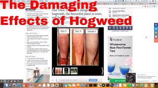 The Effects Of Hogweed Burns Can Be Long Lasting [upl. by Stavros832]