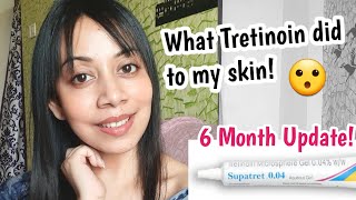 Tretinoin cream Before and After 6 Month update Supatret Tretinoin microsphere gel 004 ww [upl. by Sukramaj]