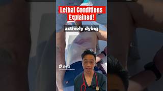 Lethal Conditions Explained  Flail Chest medicine doctor surgeon emergency [upl. by Yar]