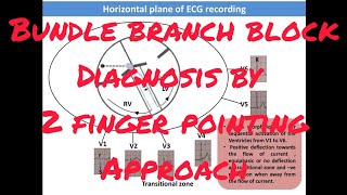 Diagnosis of Bundle branch block by two finger pointing approach by Dr Khaitan [upl. by Haon431]