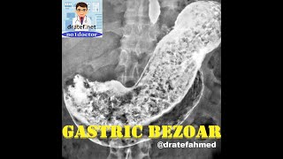 Gastric Bezoar CausesSymptoms and signs Diagnosis Bezoar Removal Endoscopic SurgicalNo1doctor [upl. by Liamsi388]