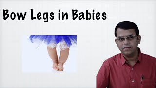 Bow legs in Babies [upl. by Silisav544]