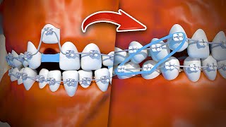 Así se componen los dientes chuecos [upl. by Belanger]