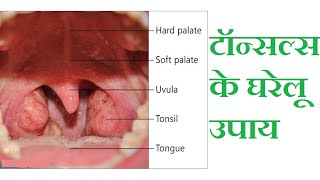 टॉन्सिल्स के घरेलू उपाय  टॉन्सिल्स की समस्या से निजात  Solve the problem of tonsils [upl. by Lavern881]