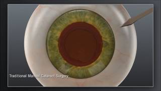 Laser Cataract Surgery with AMOs Catalys® Laser [upl. by Nerwal]