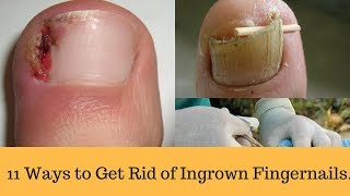 11 Ways to Get Rid of Ingrown Fingernails [upl. by Elleirad]