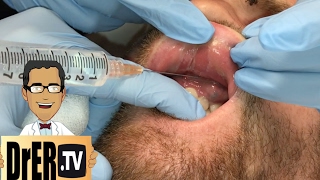 gum abscess drainage  Full VIDEO [upl. by Sandberg]