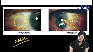 Ophthalmology PYQsFMGE36  Dr Niha Aggarwal [upl. by Herring]