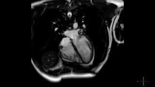 Cardiac MRI scan of a heart beating in high resolution  ECG gated CMRI in HD  real time scan [upl. by Ede519]