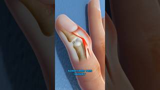 What is mallet finger 3D Animation [upl. by Hadleigh439]