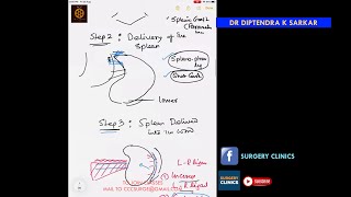 CCC Anatomy amp Operations  Splenectomy  Diptendra Sarkar [upl. by Carol]