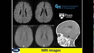 Periventricular leukomalacia in CT and MRI [upl. by Araed136]