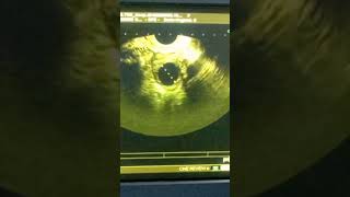 12th day ultrasounddominant follicle ultrasound ultrasoundguidance [upl. by Nodearb]