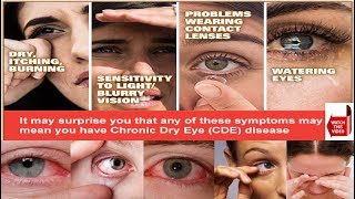 DRY EYE SYNDROME  PATIENT EDUCATION AND INFORMATION  CAUSES SYMPTOMS TREATMENT [upl. by Adneral]