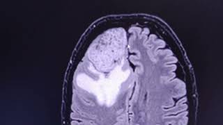 Aggressive meningioma  CT venogram and MRI [upl. by Aid]