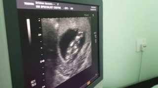 13 weeks ultrasound girl or boy [upl. by Nekcerb]