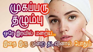 முகப்பரு மறைய  Pimple marks removal Homeremedies in Tamil Beauty Tips to remove pimples at Home [upl. by Delmor]