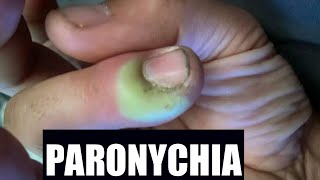 Paronychia  Katuruturu  home remedy and treatment [upl. by Dnaltiac]