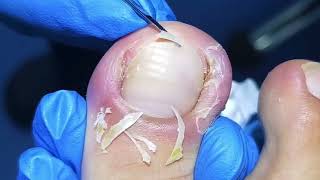 How To Remove Ingrown Toenails Step by Step With Great Result [upl. by Faxon302]