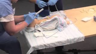 Using a Meconium Aspirator [upl. by Stover]