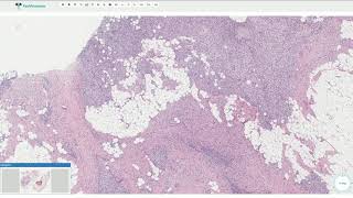 Fibrous Hamartoma of Infancy  Histopathology [upl. by Emmery70]