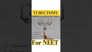 TUBECTOMY  STERLISATION [upl. by Novy992]