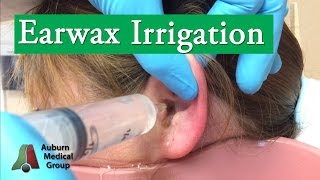 Ear Wax Irrigation  Auburn Medical Group [upl. by Darin]