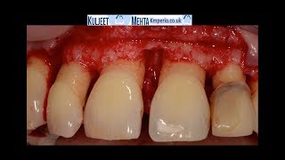 Periodontal Surgery Upper Front Teeth [upl. by Wynny510]