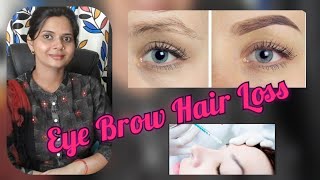 Alopecia Areata of Eyebrows Eyebrow Hair Loss Treatment of Eyebrow Hair Loss [upl. by Andromeda94]