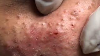 How to remove blackheads and whiteheads at homeHow to remove acne30 [upl. by Kirchner]