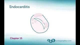 INFECTIVE ENDOCARDITIS ECHOCARDIOGRAPHY  BASICS OF IE Transthoracic vs Transoephophageal Echo [upl. by Thisbe]