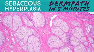 Sebaceous Hyperplasia Dermpath in 5 Minutes dermatology pathology sebaceous filaments [upl. by Anthea451]