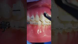 Orthodontics and Braces Improving Teeth Alignment [upl. by Aerised]