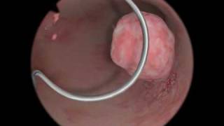 Polypectomy  Polyp Removal  Virtual Reality Simulation for Endoscopic Surgery [upl. by Rieger]