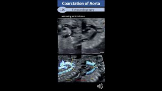 Coarctation of Aorta pediatric amp Adult [upl. by Idac702]