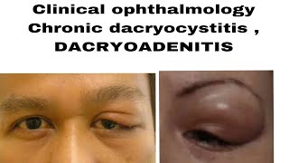 Clinical ophthalmology chronic dacryocystitis DACRYOADENITIS acute and chronic in easiest way [upl. by Yllop90]