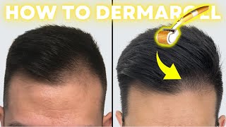 How to Derma Roll for Quickest Hair Results StepbyStep Guide [upl. by Ringler123]