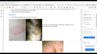 Plab 1 Lectures Dermatology Part 11 Acnae Rosacea Pityriasis Rosea Scabies [upl. by Nilad]