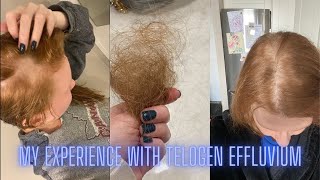 My Experience with Telogen Effluvium [upl. by Espy]