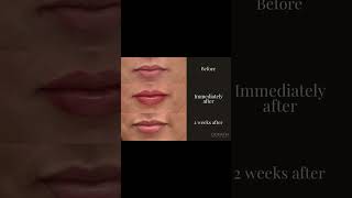 Lip filler in stages lipaugmentation drdonath [upl. by Hoban]