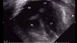 Anomalous Pulmonary Venous ReturnPartial [upl. by Terrill]